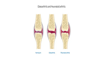 Arthritis