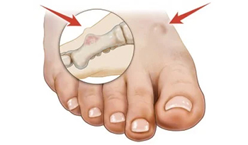 Bone Tumor