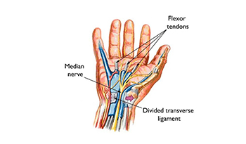 Hand Surgery