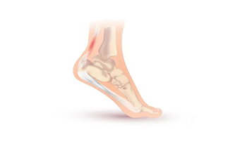 Tendonitis