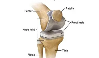 Total Knee Replacement